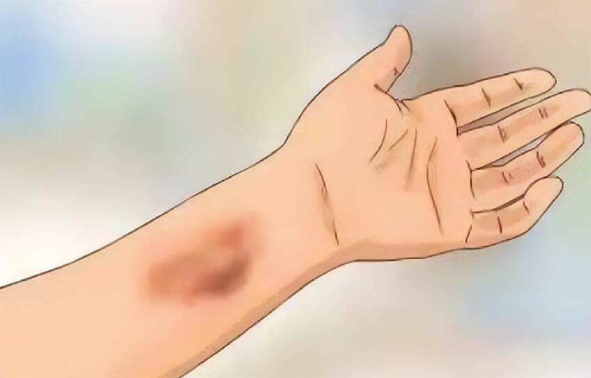女子身上沒磕沒碰卻青紫一片！醫生警告：這不是「鬼掐的」是血管在「求救」