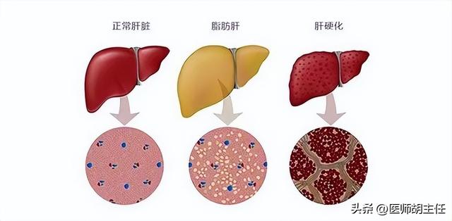 醫生提醒：一旦患上脂肪肝，這3物就別吃了，不要害了自己