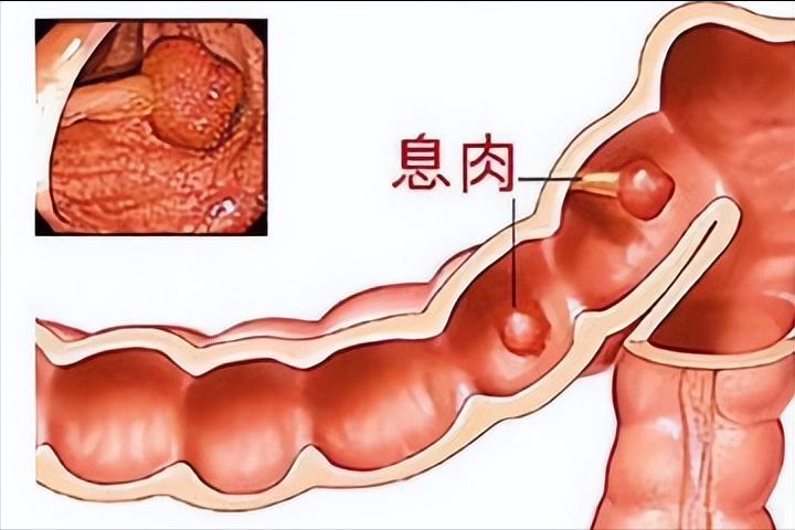 體檢時要警惕！身上長出來的「5種肉」可能是癌症先兆　突然變化快且增大：要小心了