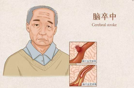 55歲婦人突發腦中風過世！醫生提醒：冬天再冷，也不要做這4件事