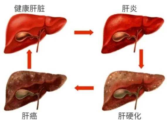 28歲男博士「每天一杯牛奶」卻得了肝癌！醫師大罵無知：牛奶怎麼可以這樣喝