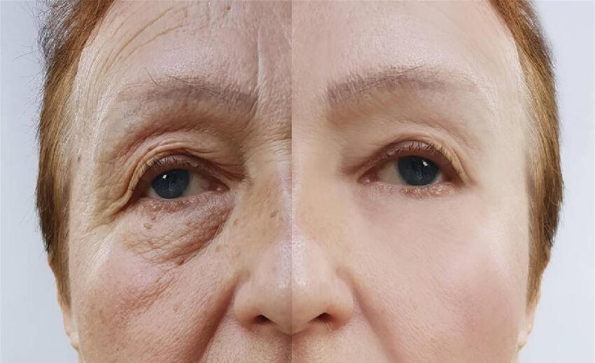 為什麼有些人滿臉「老年斑」，有的卻乾乾淨淨呢？醫生說出實情