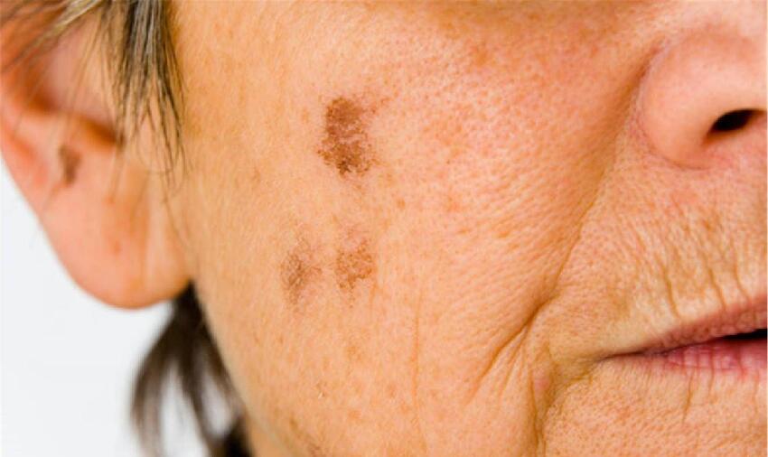 為什麼有些人滿臉「老年斑」，有的卻乾乾淨淨呢？醫生說出實情