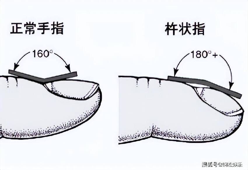 體內有癌，手指先知？注意：手指出現這些癥狀，可能是疾病的信號