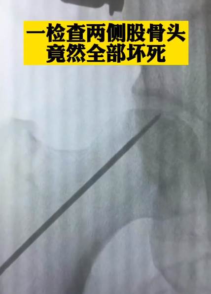 27歲男每天喝7、8瓶！走路掰咖去檢查，醫歎：「骨頭全壞死了」