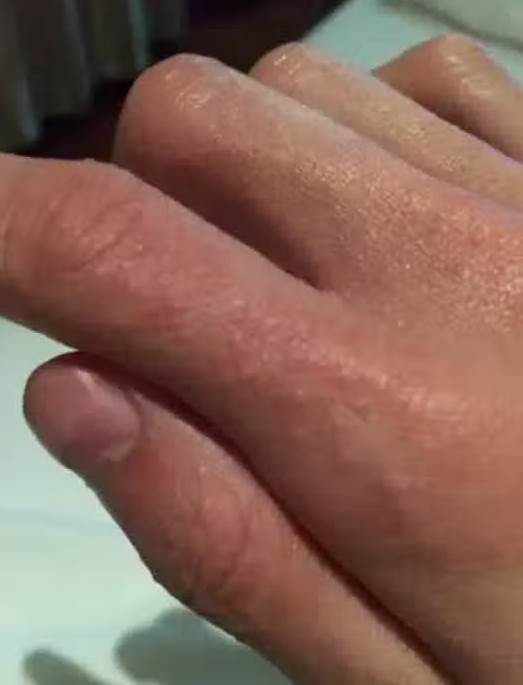 手腳狂冒「小水泡」越抓越癢！醫師警告：千萬別抓「1招急救」不花半毛錢速消止癢！