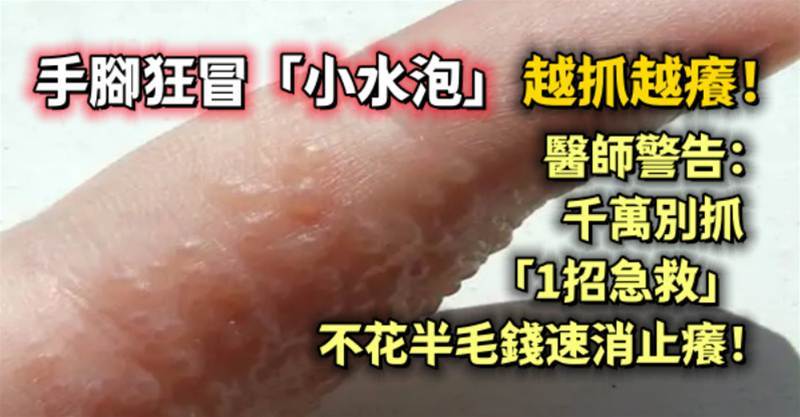 手腳狂冒「小水泡」越抓越癢！醫師警告：千萬別抓「1招急救」不花半毛錢速消止癢！