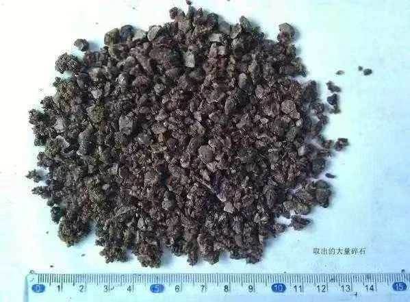 男人手術後從體內取出「420顆」腎結石,醫生看完差點嚇暈!只因為他長年吃「這種東西」.