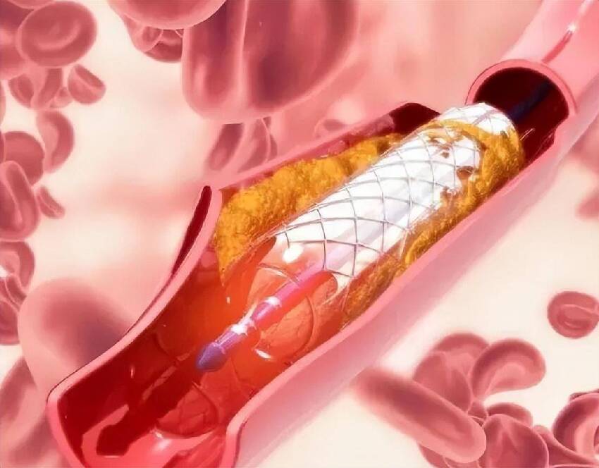 血栓「大戶」被揪出，是肥肉的10倍？醫生：經常吃，血管或扛不住