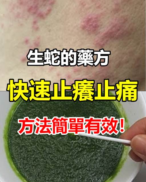 生蛇的藥方,快速止癢止痛,方法簡單有效!