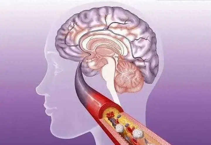 醫生說：中老年人不想讓腦梗找上你，日常做到5個「不」！