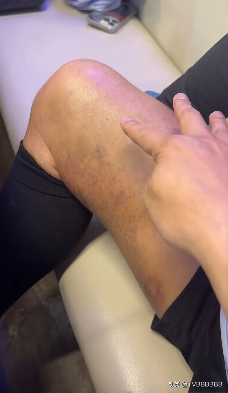 觸目驚心！香港知名男星血管爆了大片瘀黑，曾揚言隨時接受安樂死