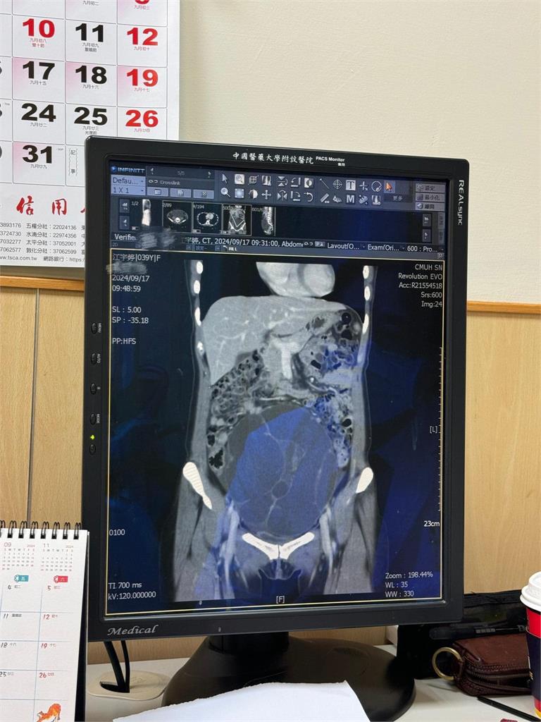 網紅江老師突曝下腹長「19公分腫瘤」急開刀化驗！淚曝最慘恐拿掉子宮