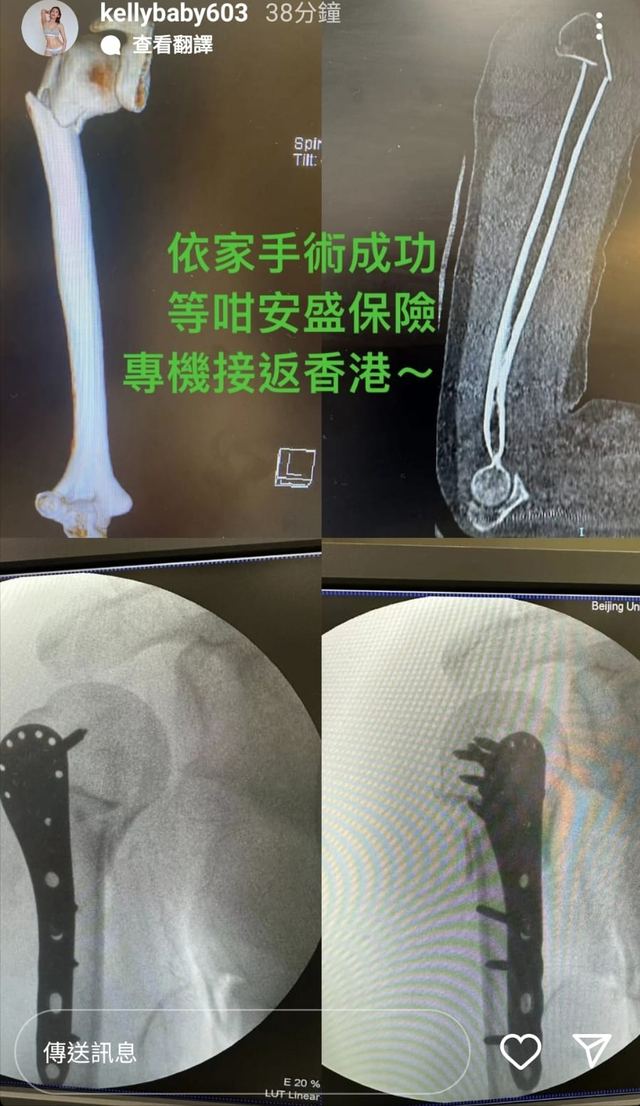 30歲香港女星長白山旅遊遇意外！苦熬10小時飛北京手術等專機返港