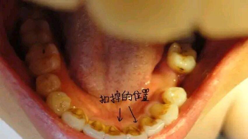 從牙齒扣下來的「黃臭泥」是什麼？怎麼做才能避免這種東西呢？