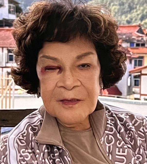 89歲周遊一口氣「拔掉上排植牙」最新模樣曝　認不敢見人「怪年輕太愛美」