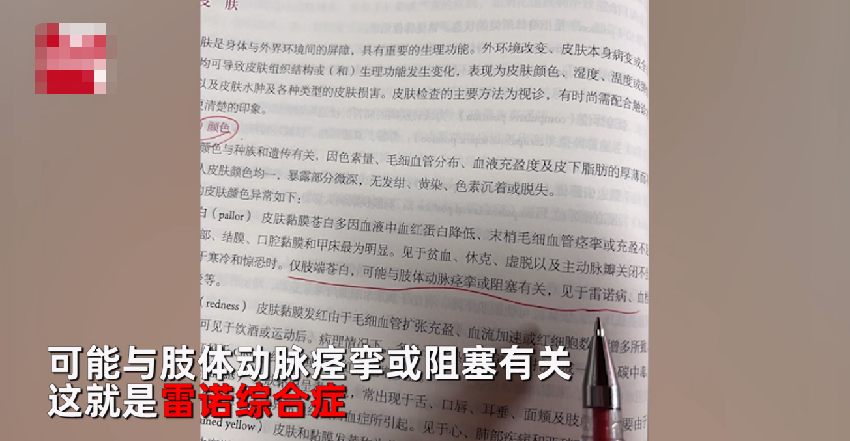 一到冬天就手腳冰涼！女教師曬「手部照片」抱怨　「醫學生一看」連忙喊話：趕快去醫院