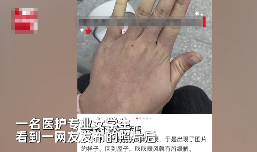 一到冬天就手腳冰涼！女教師曬「手部照片」抱怨　「醫學生一看」連忙喊話：趕快去醫院