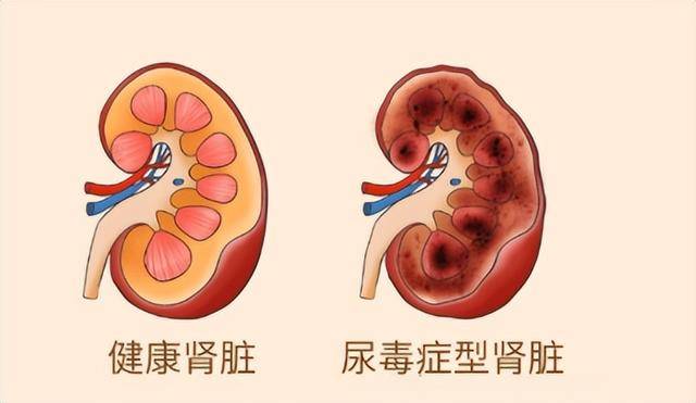 晚上睡覺時，身體一旦出現這5種變化，說明你的尿酸已「超標」！