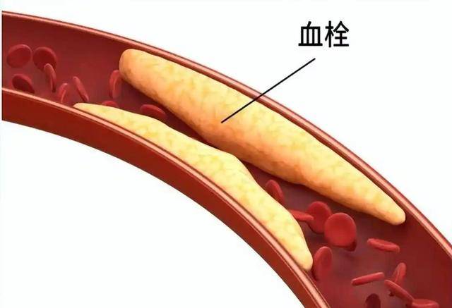 晚上睡覺時，身體一旦出現這5種變化，說明你的尿酸已「超標」！