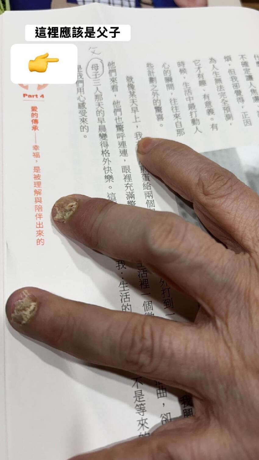 79歲黃越綏10根手指「變形潰爛」！感染惡疾病況曝光