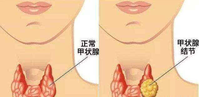 菠菜是結節的加速器!醫生提醒:不想結節癌變,盡量少吃8種食物