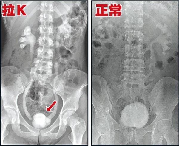 高雄16歲高中生「只因這東西就終生包尿布」！醫師嘆氣：一輩子沒救了！一定要轉出去，爸媽千萬注意孩子的舉動！