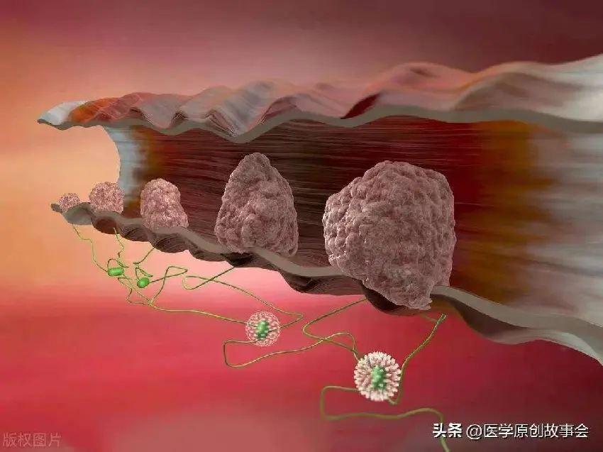 醫生忠告：腸息肉不想變腸癌這「4種東西」盡量少吃：再饞也要忍住‼️