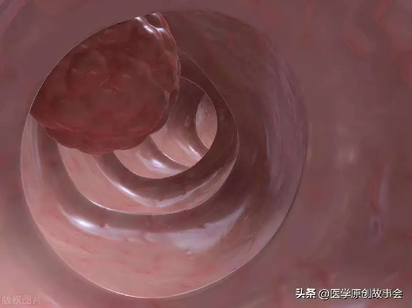 醫生忠告：腸息肉不想變腸癌這「4種東西」盡量少吃：再饞也要忍住‼️