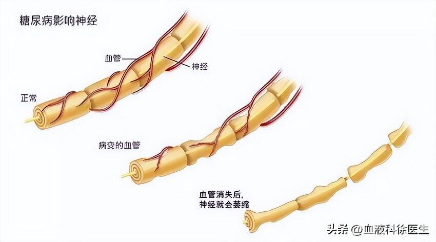 50歲大叔血糖「從14.5降到5.2」！醫生認證：他的「3個降糖習慣」值得學習