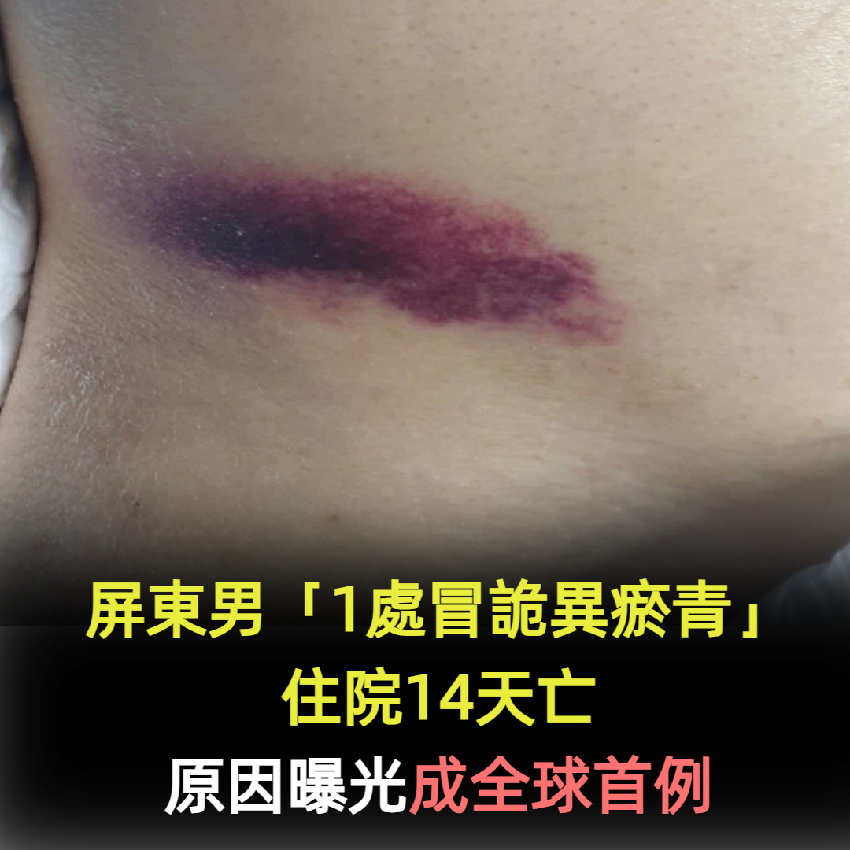 屏東男「1處冒詭異瘀青」住院14天亡！原因曝光成「全球首例」