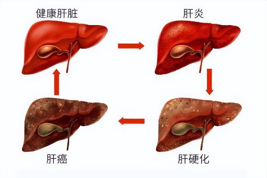 肝開始變硬，頭部會有5個異常，若一個也沒有，說明肝臟還很健康！