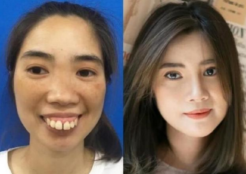 牙齒又大又凸！30歲女子因「太醜」無人敢追　參加整容節目「顏值360度大變樣」：父母都不敢認