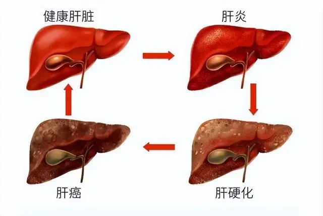 肝開始變硬，頭部會有出現5個異常，若一個也沒有，說明肝臟還很健康