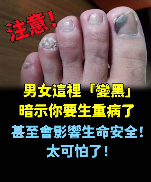 注意！男女這裡「變黑」暗示你要生重病了...甚至會影響生命安全！太可怕了！