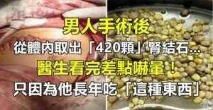 男人手術後從體內取出「420顆」腎結石，醫生看完差點嚇暈！只因為他長年吃「這種東西」