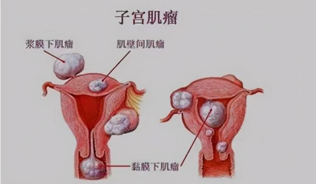 女性為什麼容易長子宮肌瘤？醫生：平時儘量避免4個行為，別忽視